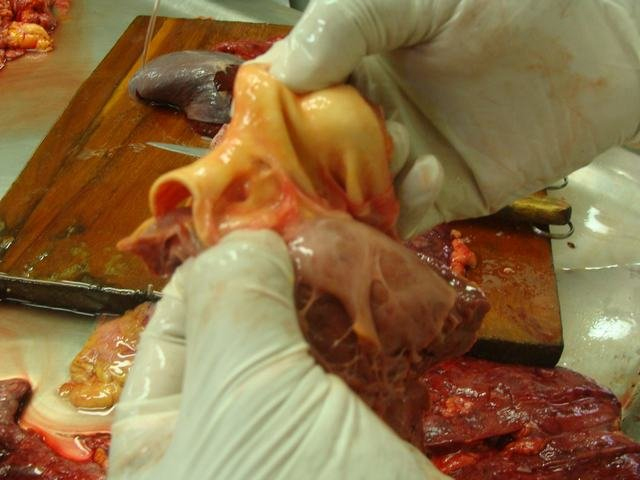 anamolus left coronary
